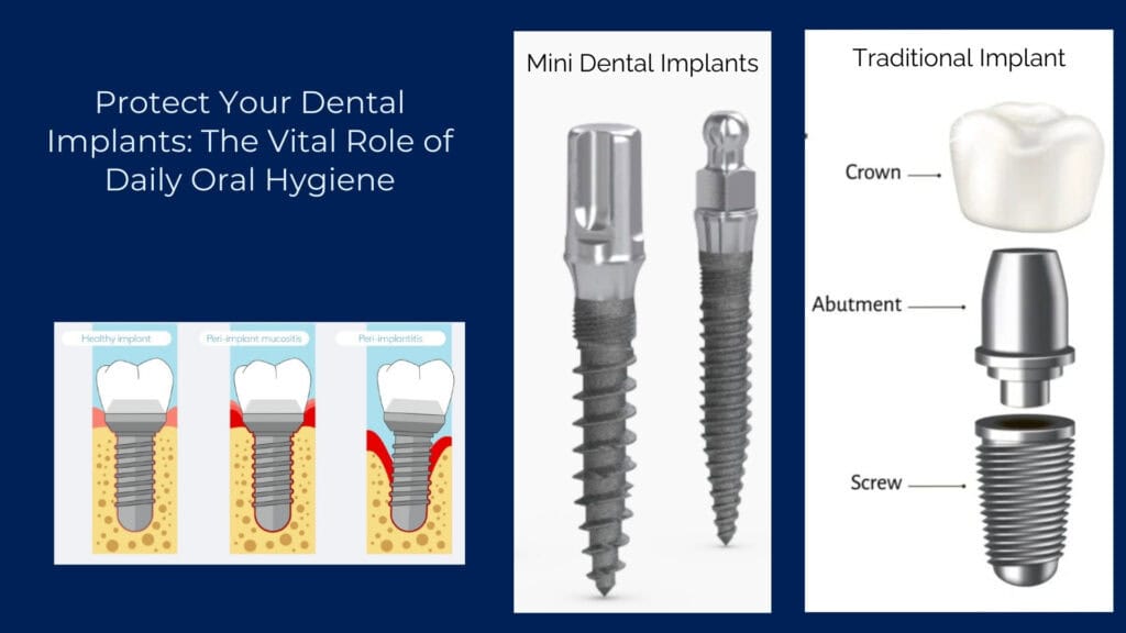 caring for your implants 2