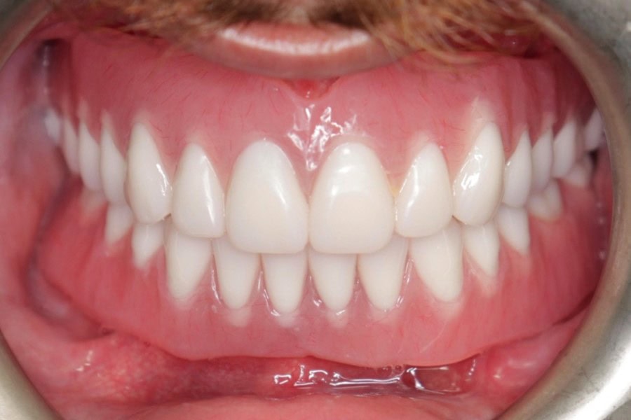 implant supported denture closeup - after