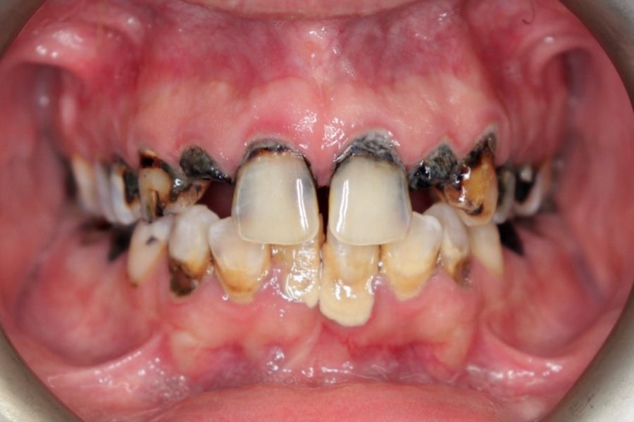 implant supported denture closeup - before