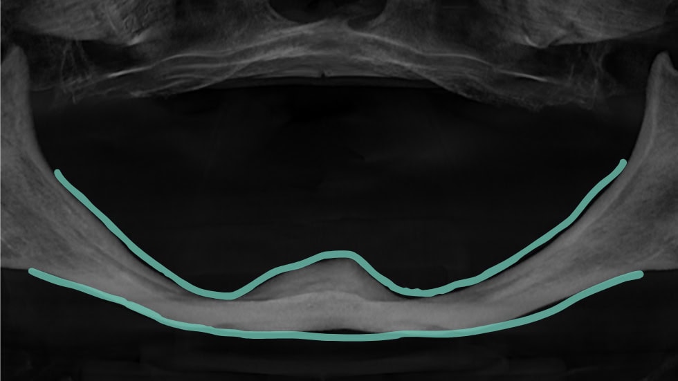 jaw bone without implants