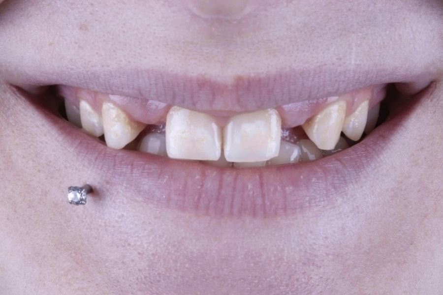 close up single implant before