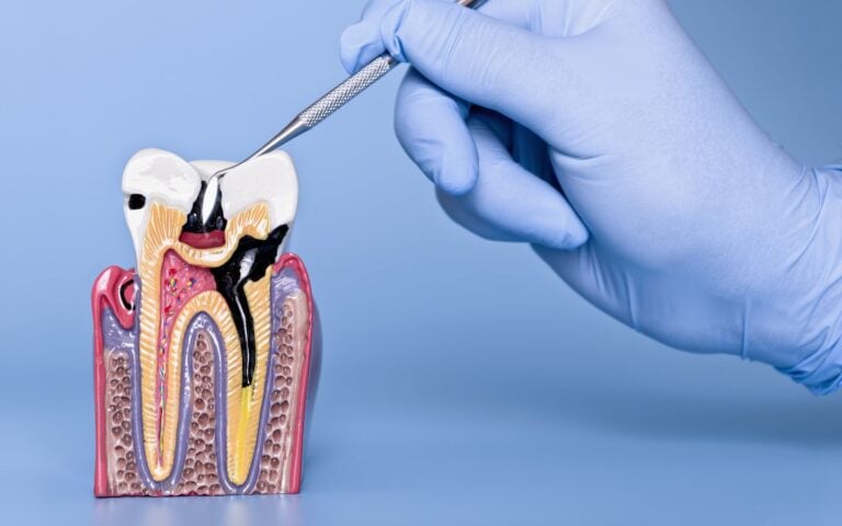 Curodont™ VS Silver Diamine Fluoride for Cavity Treatment