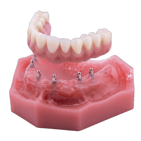 Resin-hybrid fixed bridge illustration